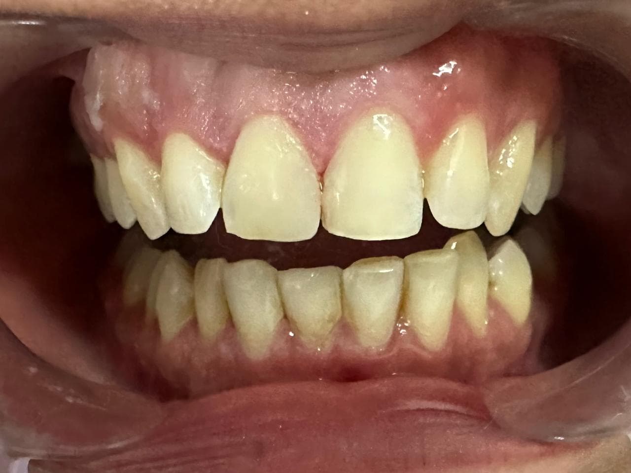 Cosmetic Dentistry - After