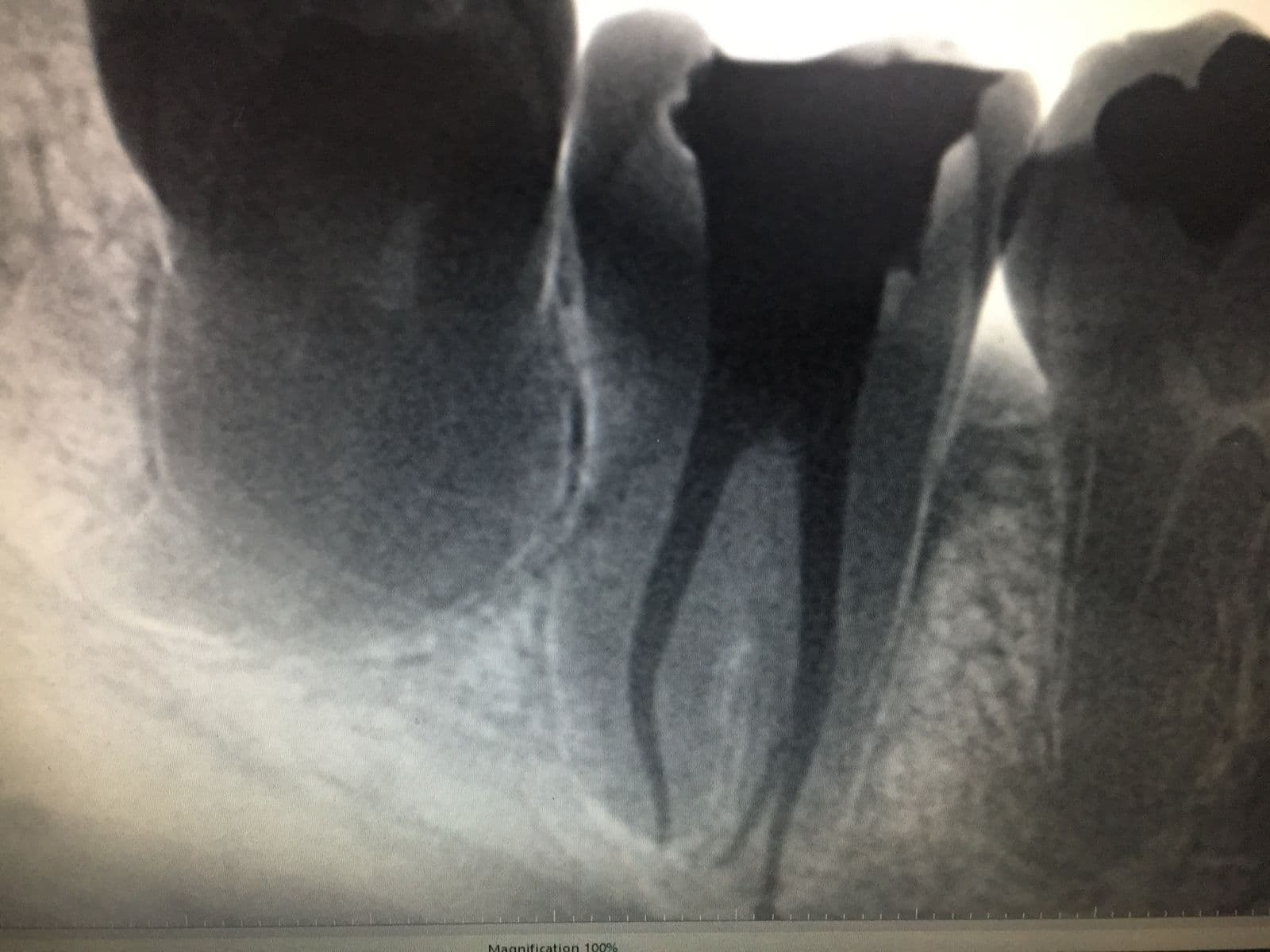 Root Canal (Single-Sitting) - Case 1