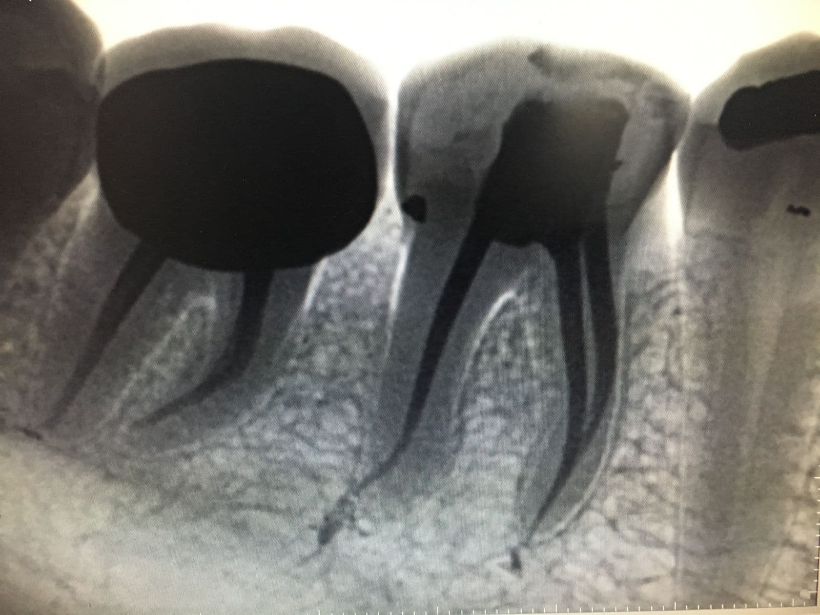 Root Canal (Single-Sitting) - Case 2